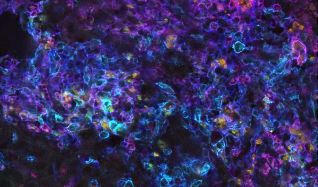 Mit der neuen Methode kann die Wachstumsgeschwindigkeit des Krankheitserregers Leishmania im Gewebe gemessen werden. Schnell wachsende Erreger erscheinen grün-gelb, langsam wachsende orange-rot. Mit modernen Färbetechniken lässt sich außerdem der Aufenthalt der Krankheitserreger in verschiedenen Zelltypen des Immunsystem bestimmen. Drei solcher Zelltypen (Makrophagen, Monozyten und dendritische Zellen) sind in pink, dunkelblau und türkis angefärbt. Foto: Sandrina Heyde und Lars Philipsen